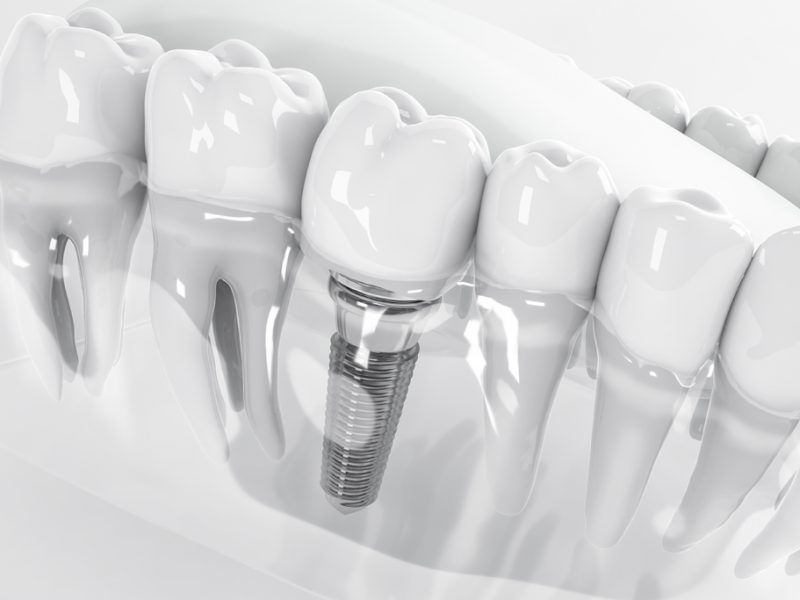 Dental Implants | Hale Courtyard Dental | Dentist in Hale Hulme | General Dentistry
