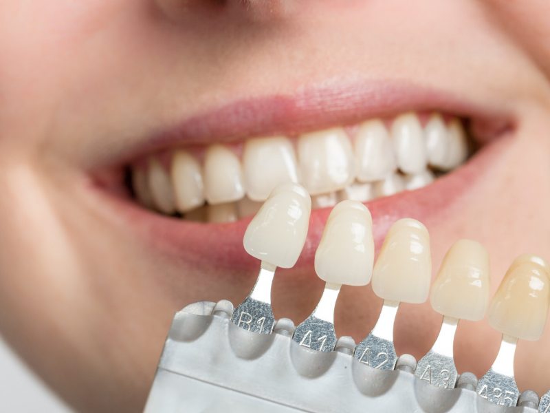 dentist using shade guide at woman's mouth to check veneer of tooth